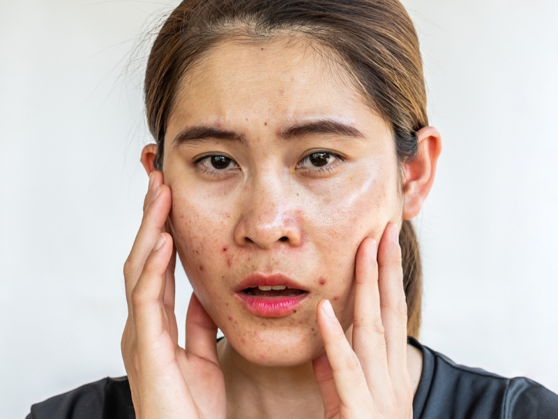 Những ảnh hưởng của mồ hôi dầu đến làn da