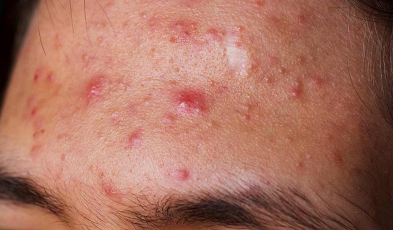 Ra mồ hôi nhièu ở mặt khiến mụn ẩn và mụn viêm xuất hiện nhiều hơn