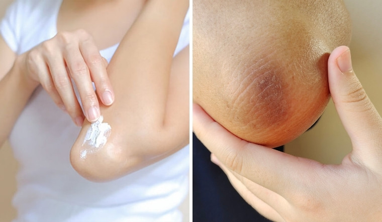 Cách trị thâm khuỷu tay hiệu quả tại nhà